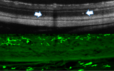 Diabetic retinopathy: early clinical signs and intervention using a Connexin43 modulator