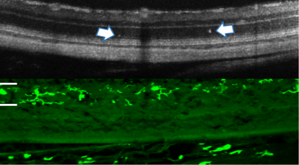 Diabetic retinopathy: early clinical signs and intervention using a Connexin43 modulator