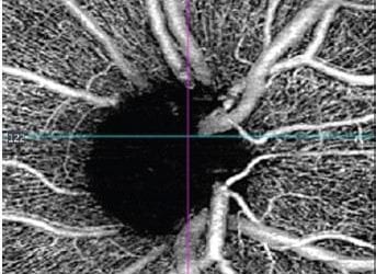 Identifying early retinal markers of frontotemporal dementia