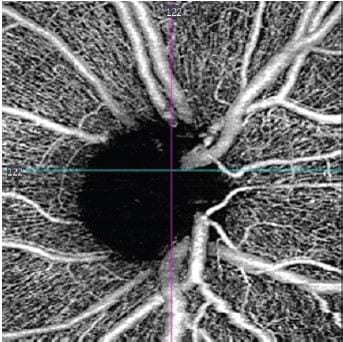 Identifying early retinal markers of frontotemporal dementia